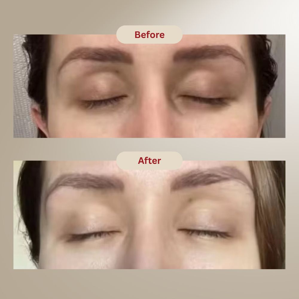 MicroInfusion Patches